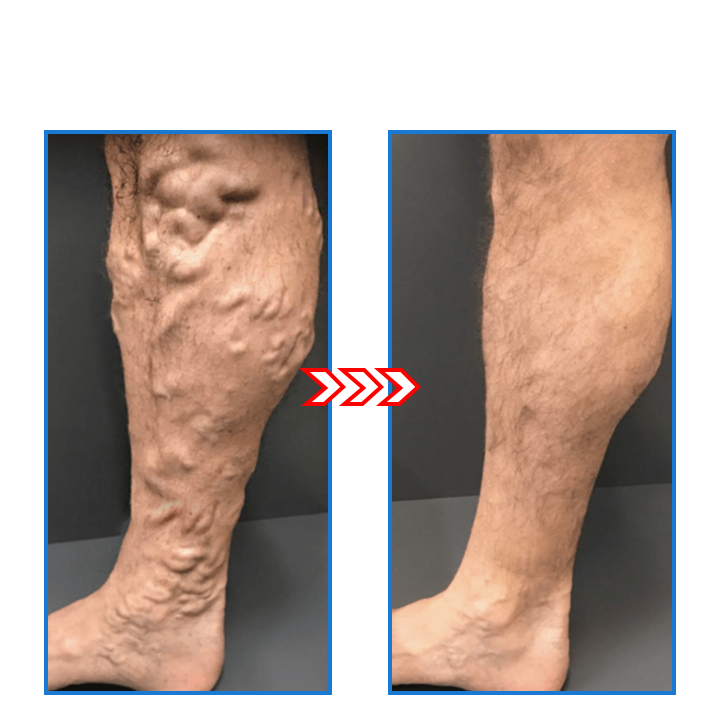 FitAura - Sirkulasjonsfremmende og hudoppstrammende sokker for slankere benp | 1+1 Gratis