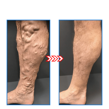 FitAura - Sirkulasjonsfremmende og hudoppstrammende sokker for slankere benp | 1+1 Gratis